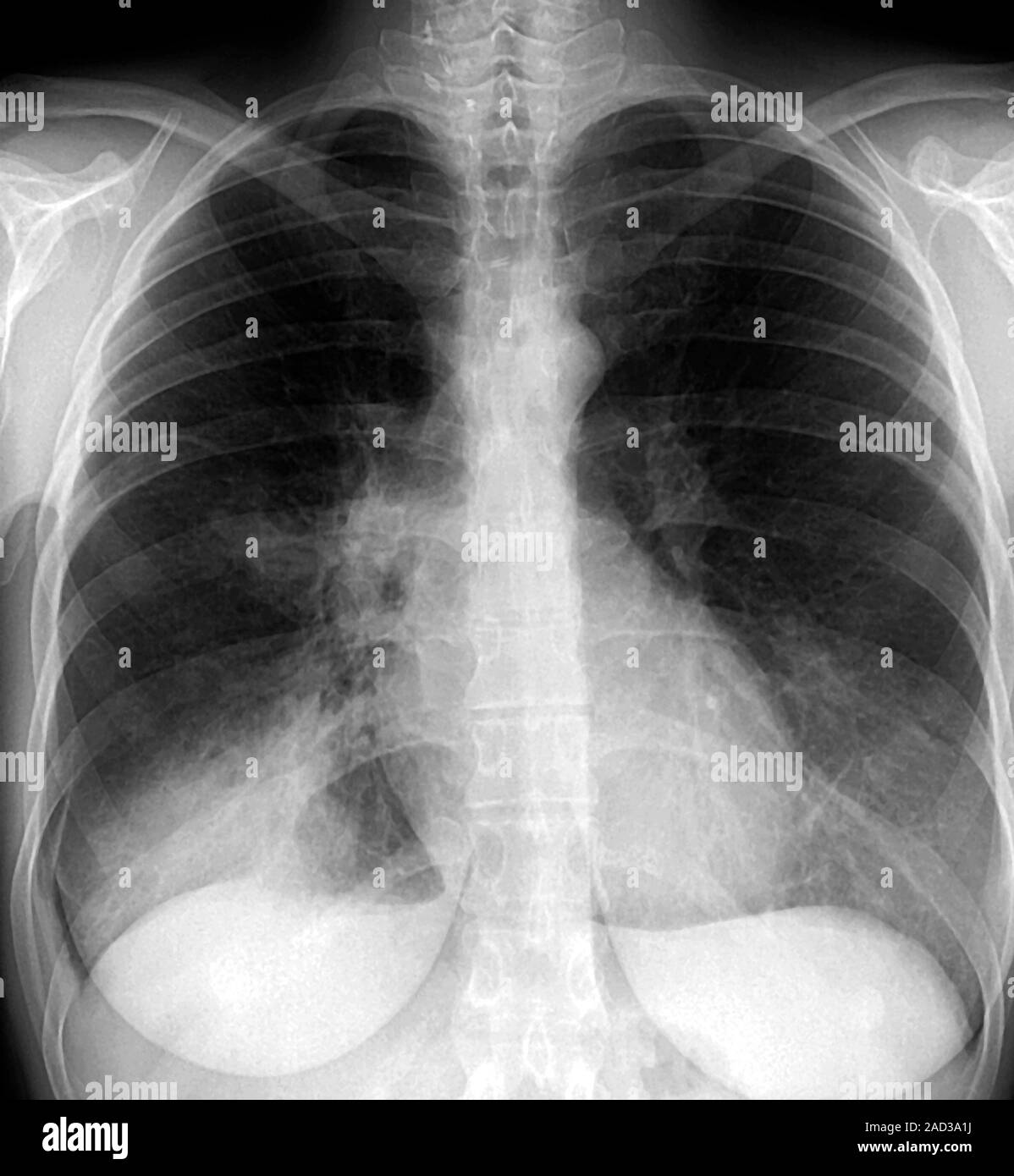 Chest infection. Frontal chest Xray of a 32yearold patient with an