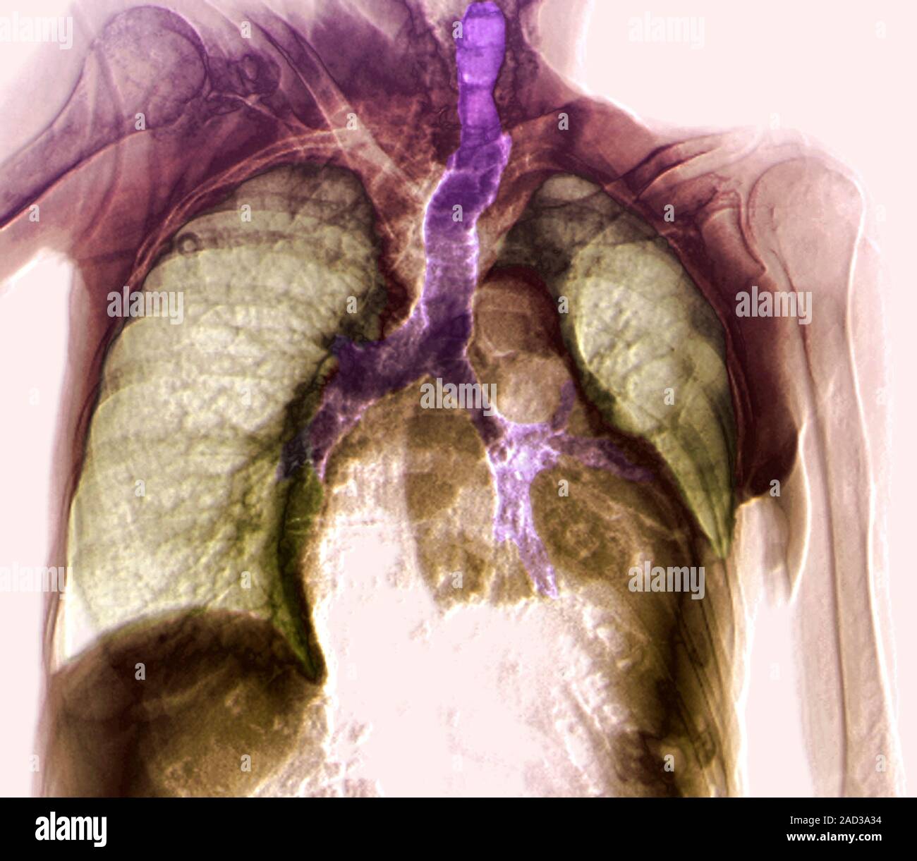 Pleural effusion. Chest X-ray of an 80-year-old patient undergoing ...