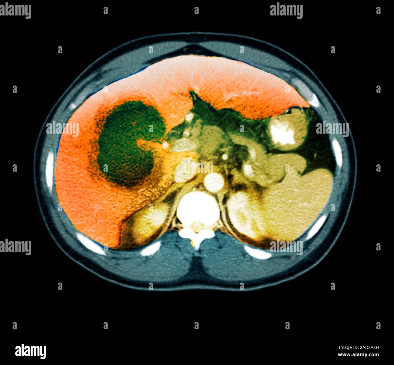 Liver abscess. Coloured computed tomography (CT) scan of an axial section through the abdomen of