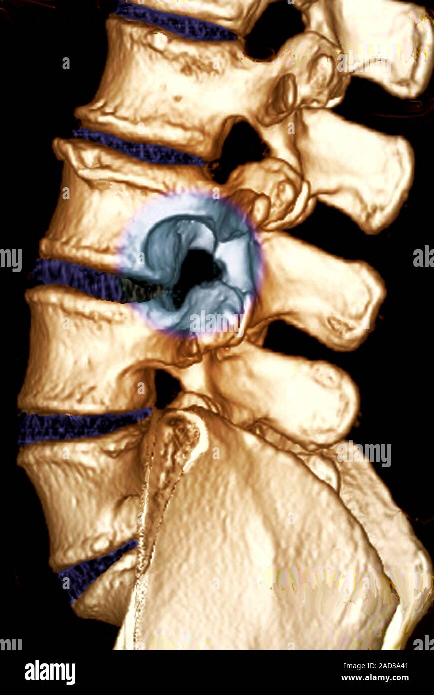 Spinal tumour. Coloured 3D computed tomography (CT) scan of the lumbar ...