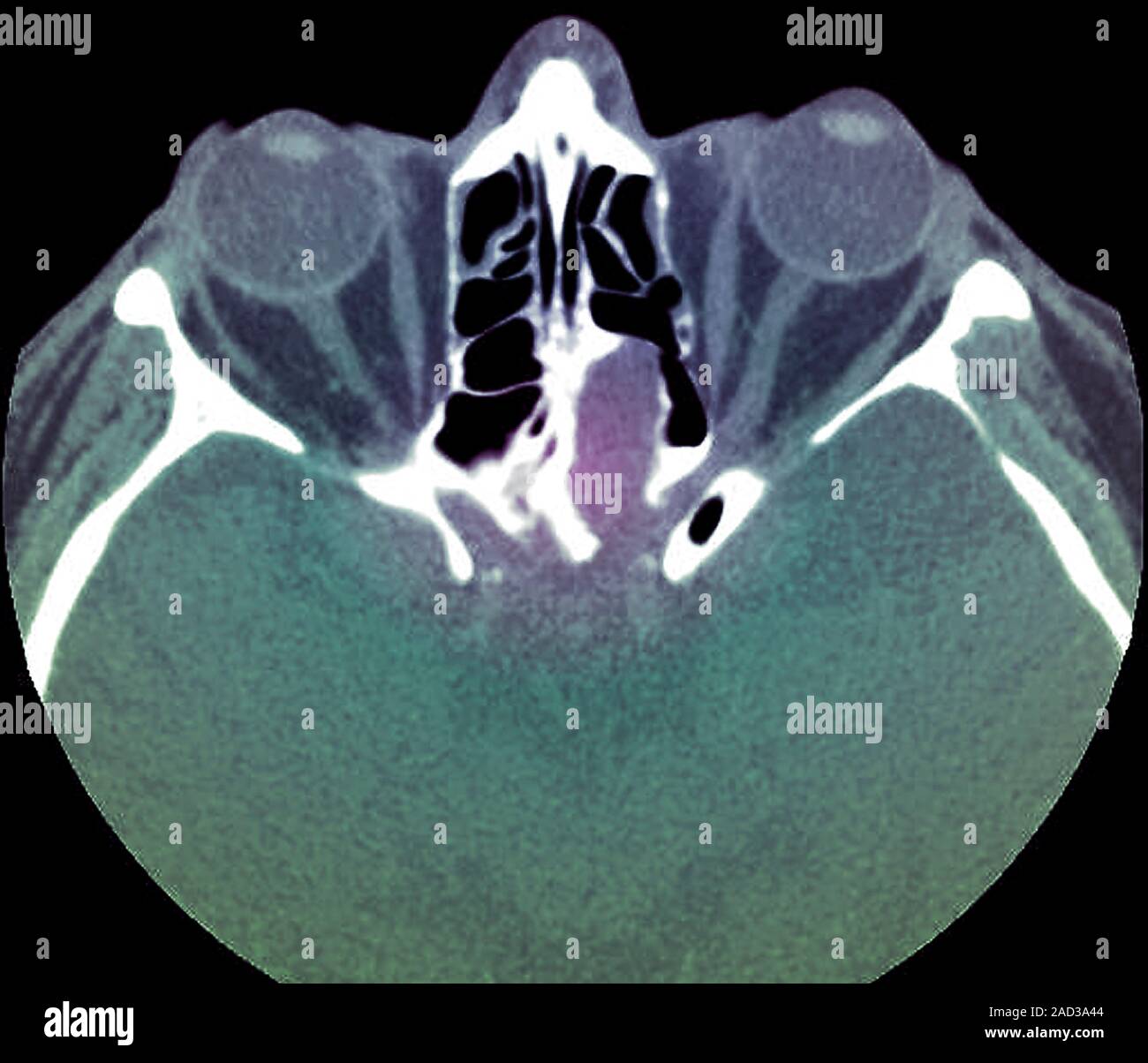 Dural tear following traffic accident. Computed tomography (CT) scan of ...