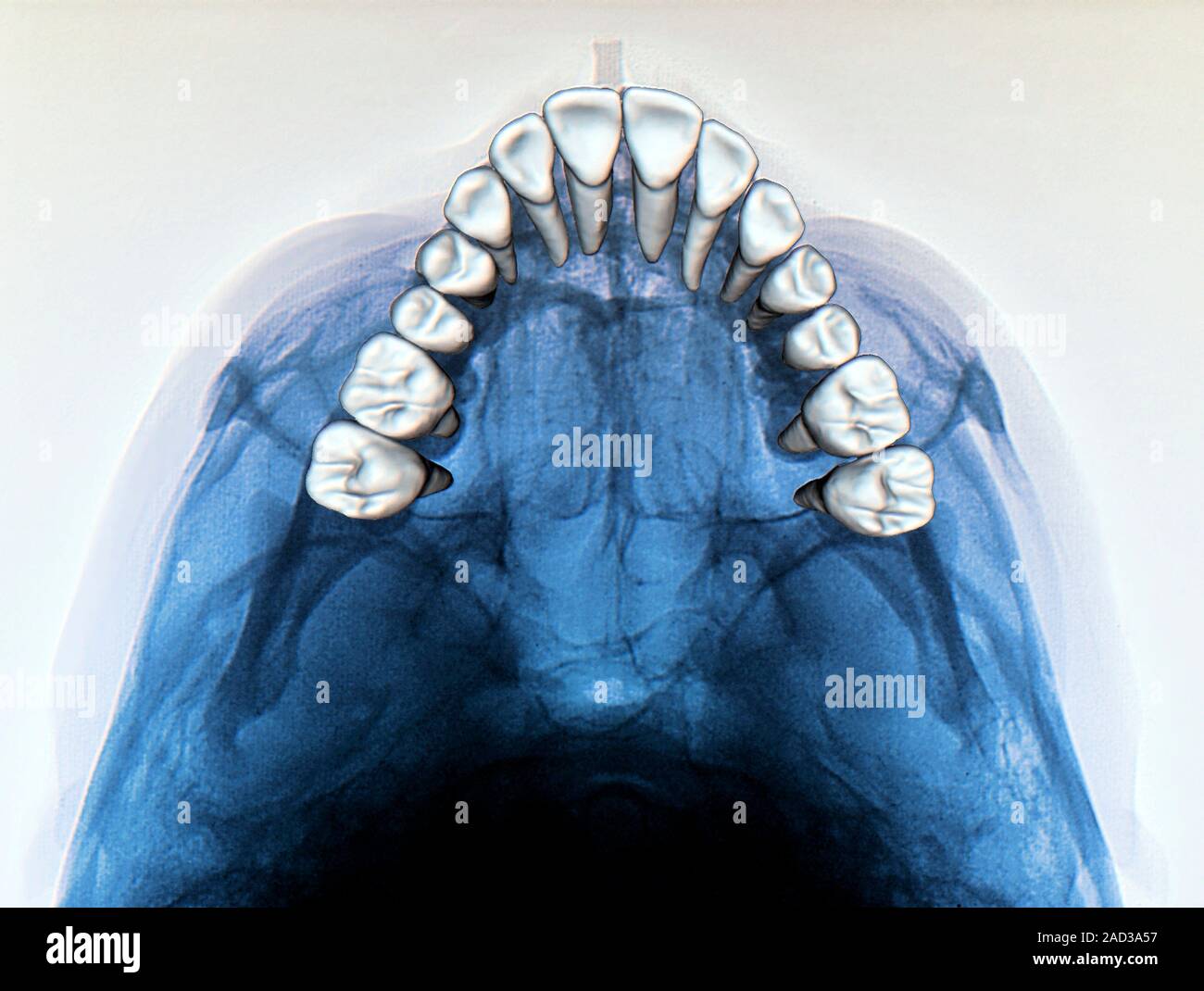 Dental arch in thumb sucking. Coloured X-ray of the dental arch of a 19-year-old patient, showing evidence of deformation due to thumb sucking as a ch Stock Photo