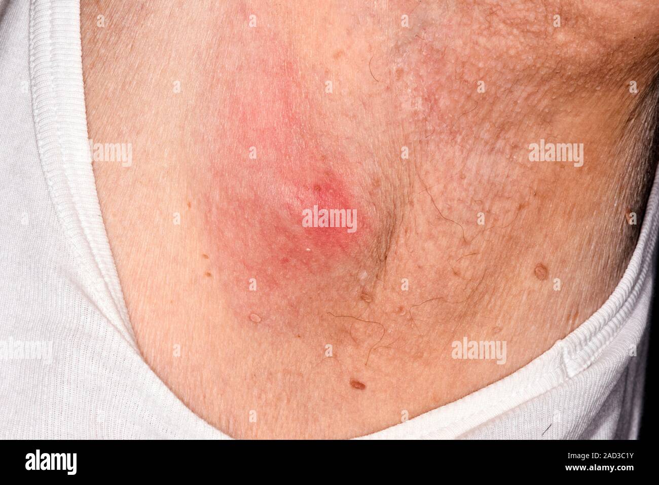 Infected sebaceous. Closeup of red skin around an infected sebaceous