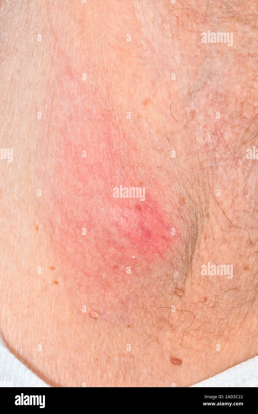 Infected sebaceous. Closeup of red skin around an infected sebaceous