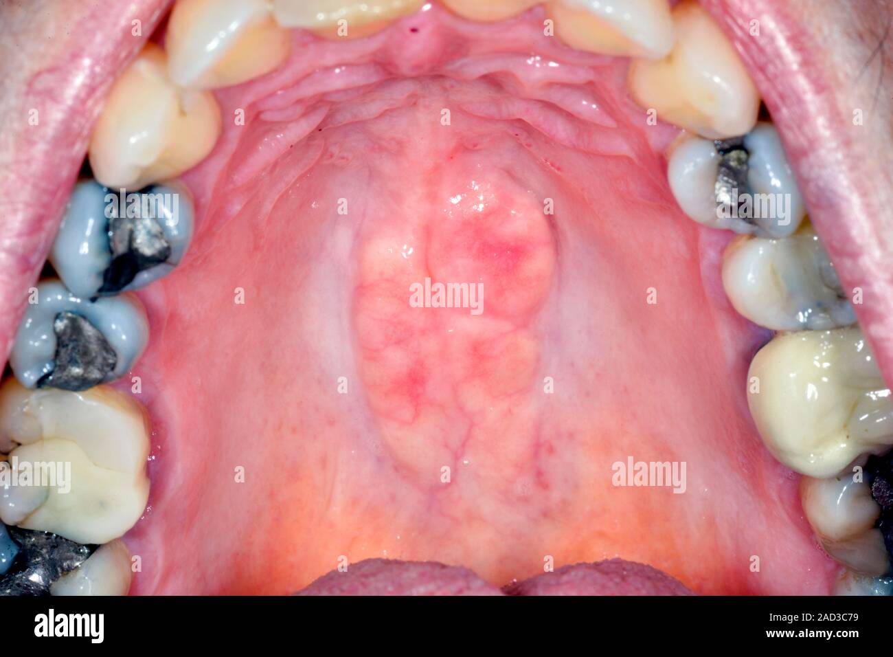 Torus palatinus. Close-up of the roof of the mouth of a 67-year-old ...