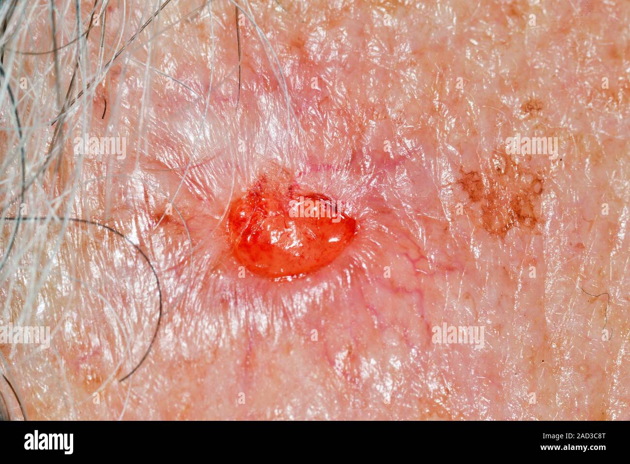 Skin Cancer Close Up Of Basal Cell Carcinoma Skin Cancer On The