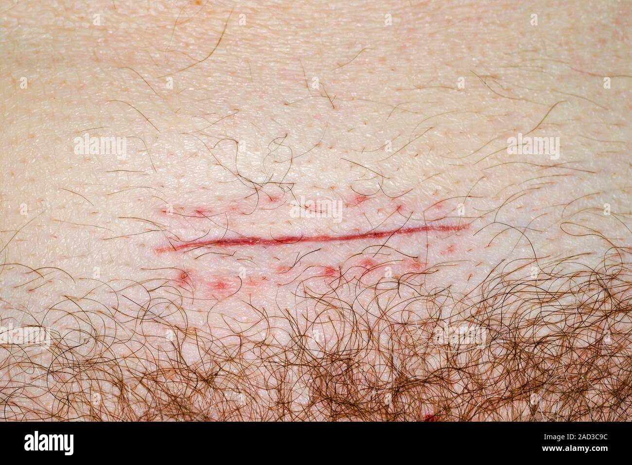 Caesarean section scar. Close-up of a scar on the abdomen of a 30-year ...