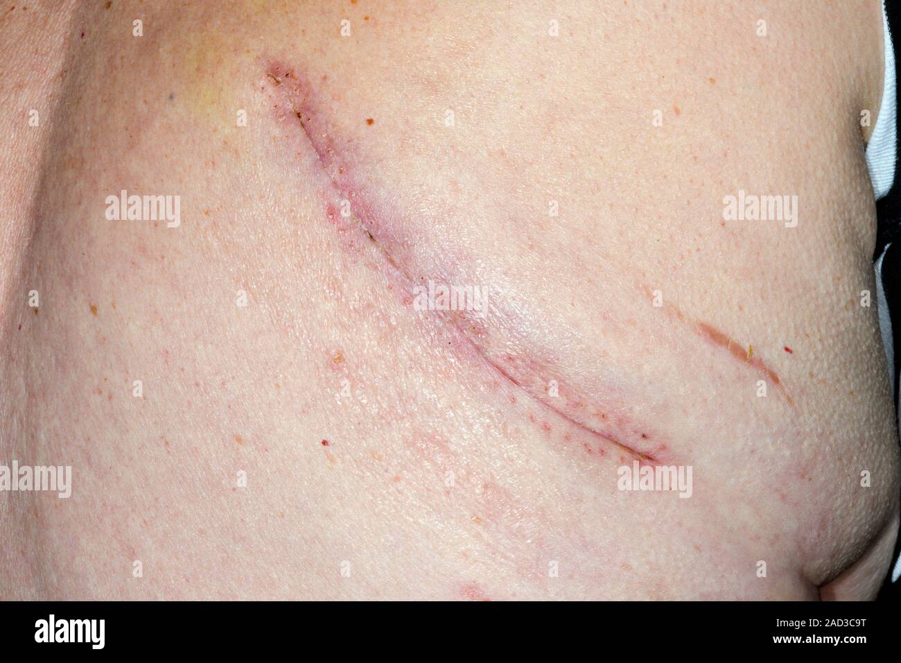Lung cancer removal scar. Closeup of a surgical scar on the chest of a