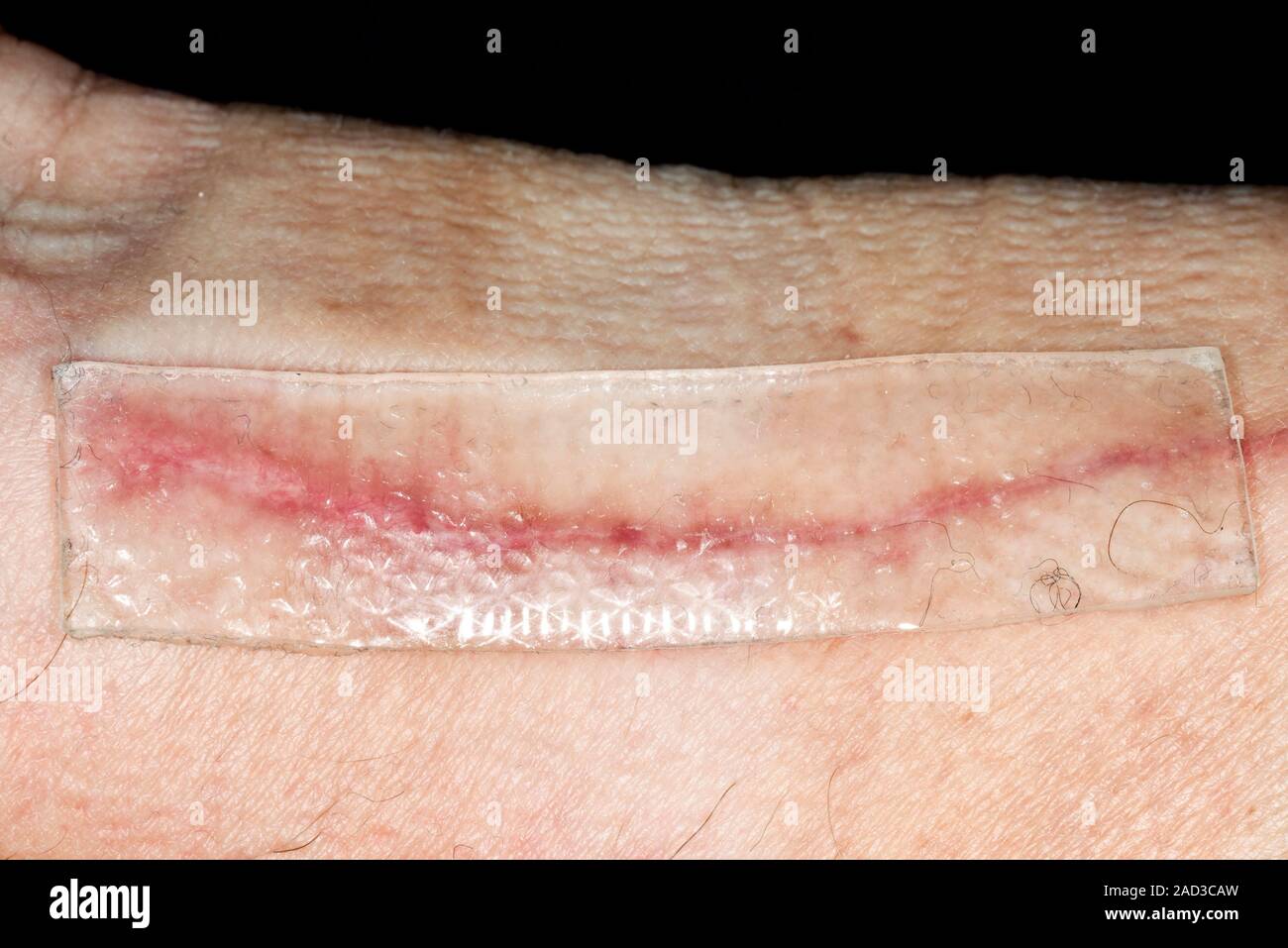Keloid scar treatment. Closeup of a silicon gel patch being used to