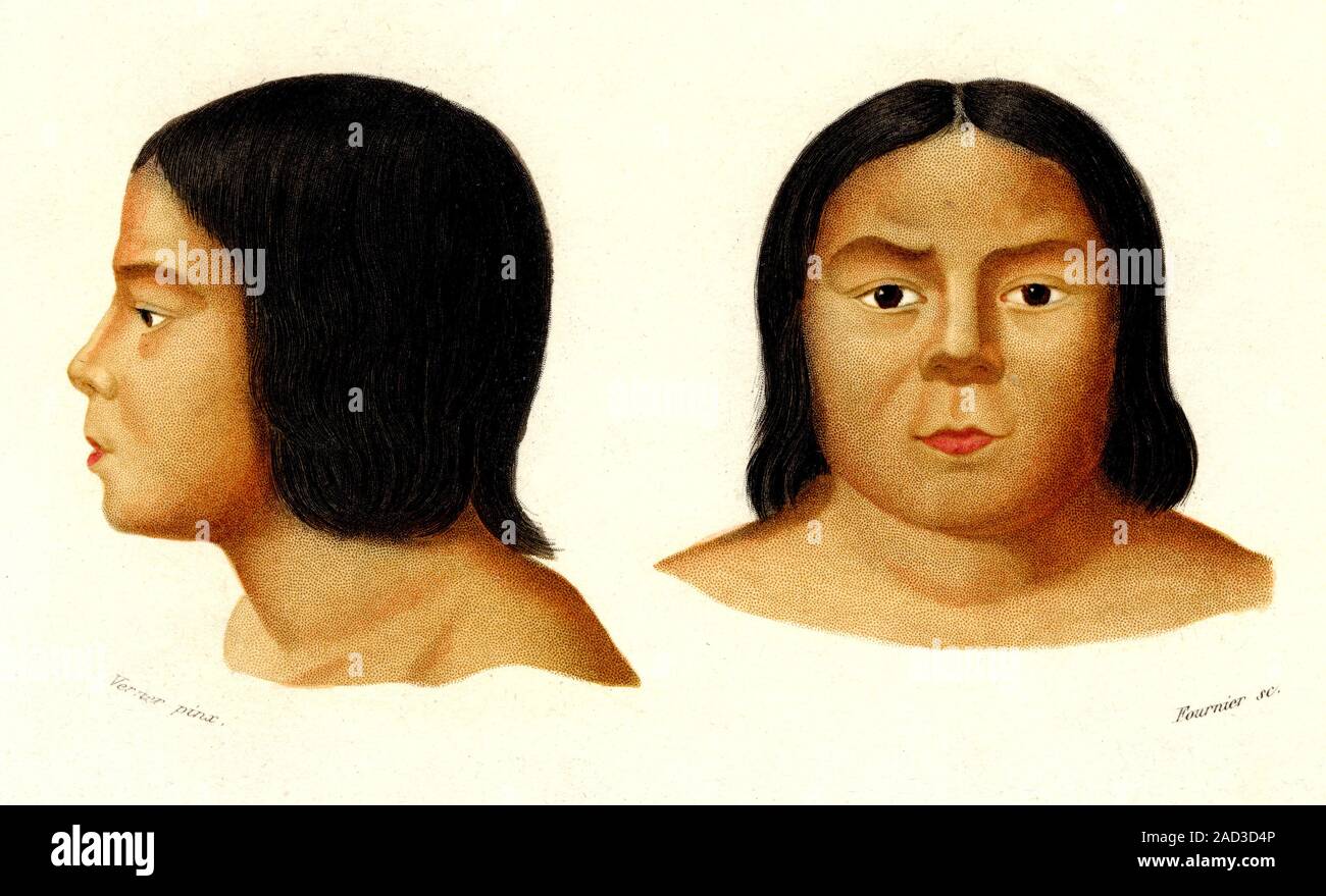 Ojibwe person. 1868 Century illustration of the head of an Ojibwe
