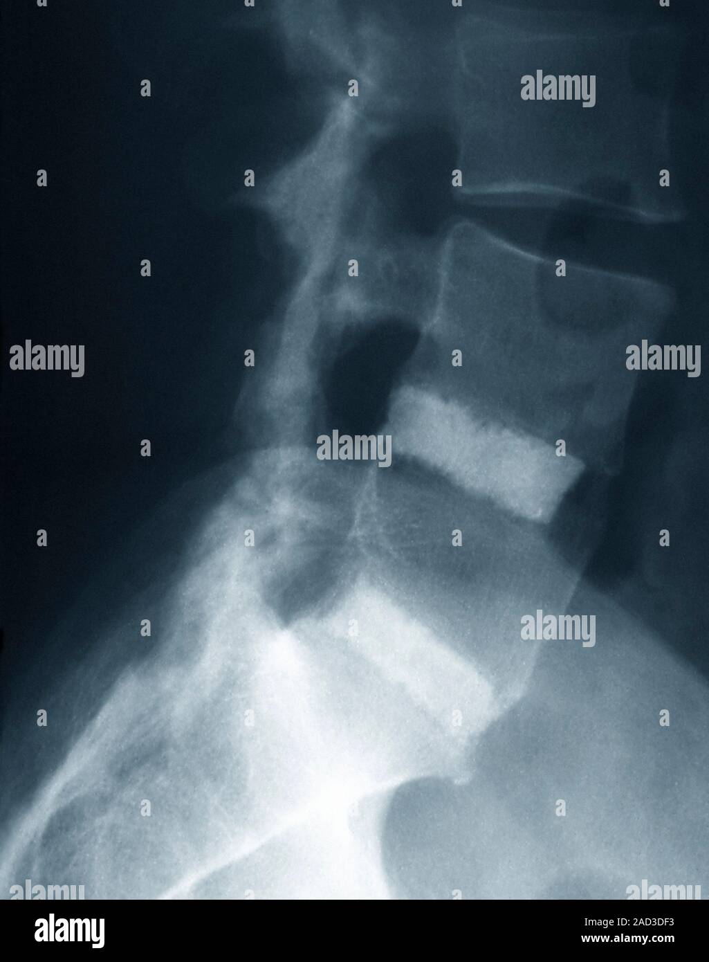 Spinal fusion for slipped discs. Xray of the lumbosacral spine of a 42