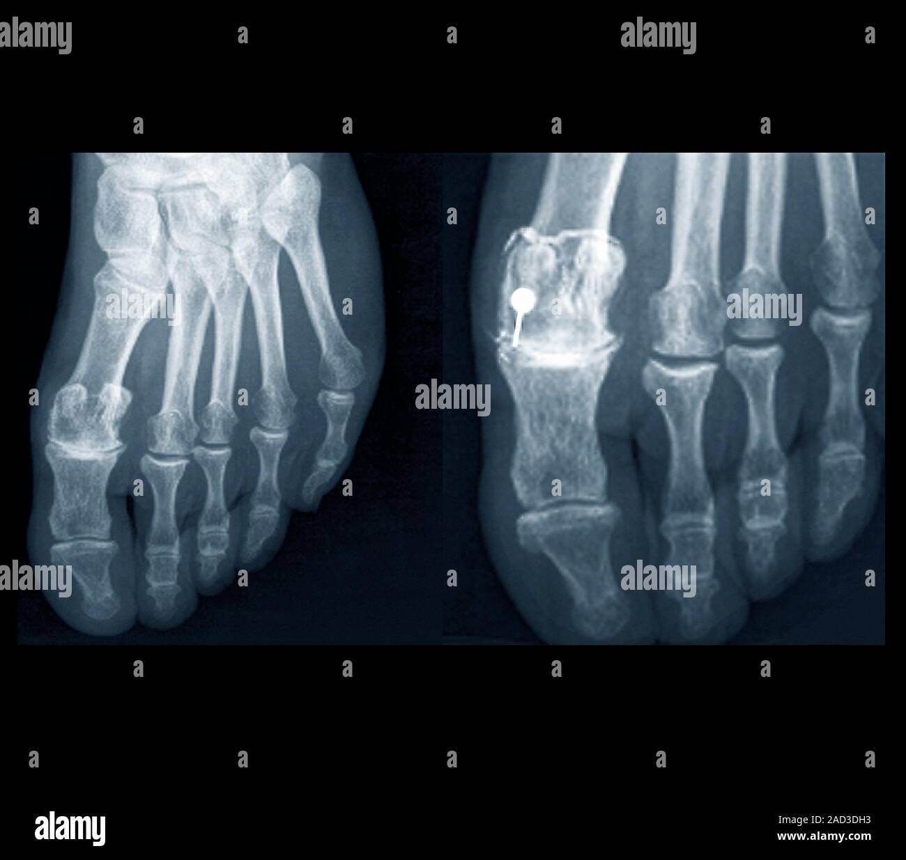 Osteoarthritis of the foot. Xrays of the left foot of a 75yearold patient with osteoarthritis