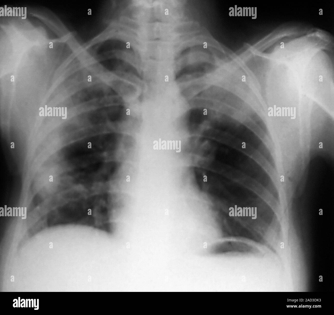 Abdominal air pockets. Frontal chest Xray of a 62yearold patient