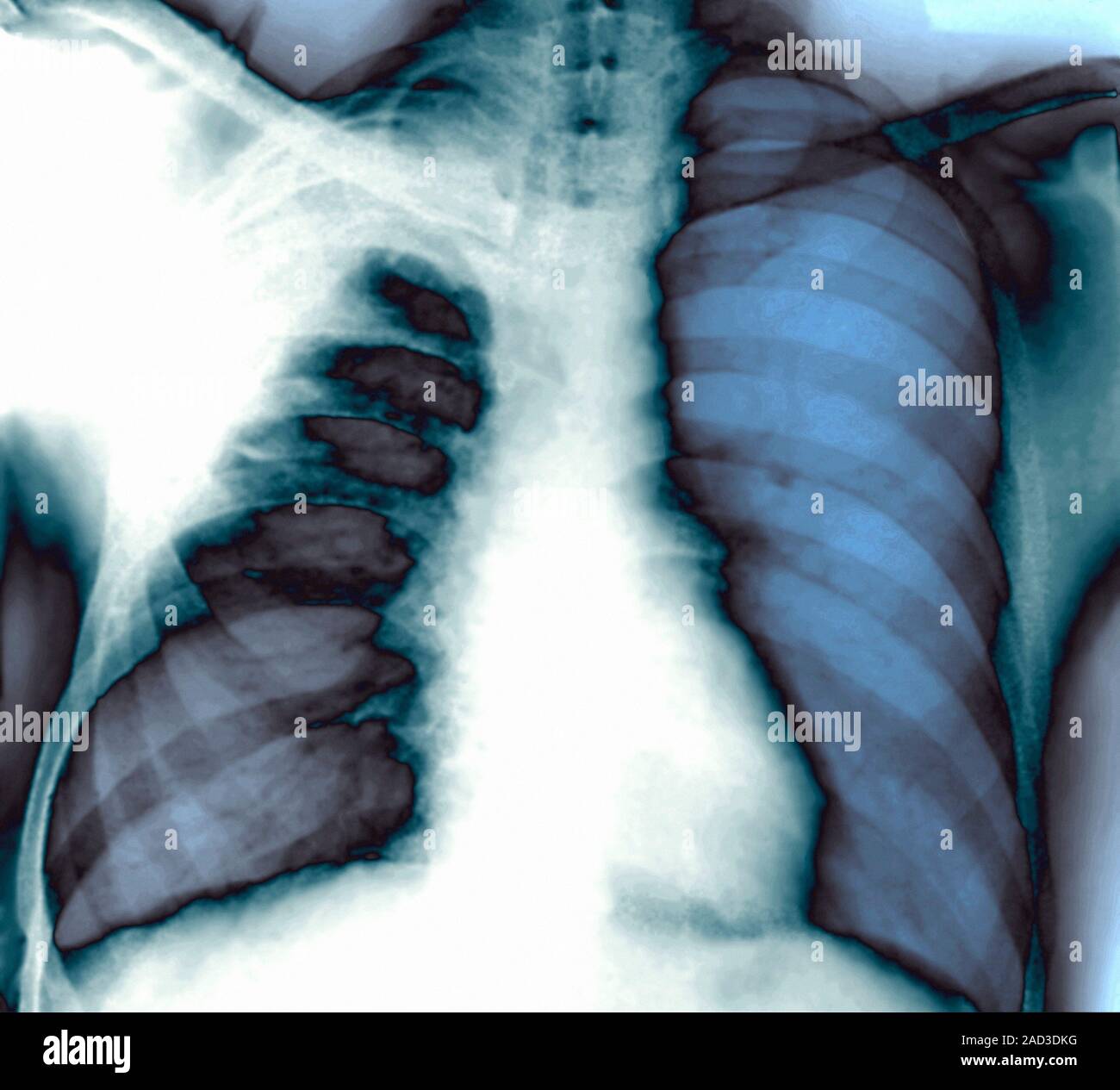 Pleurisy. Frontal X-ray of an axial section through the chest of a 45-year-old male patient with pleurisy, showing localised thickening of the pleura Stock Photo
