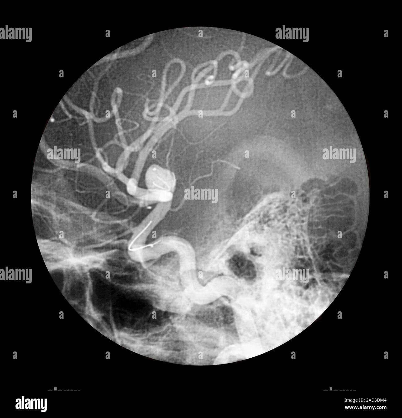 Brain aneurysm. Angiogram (X-ray) of a section through the base of the ...