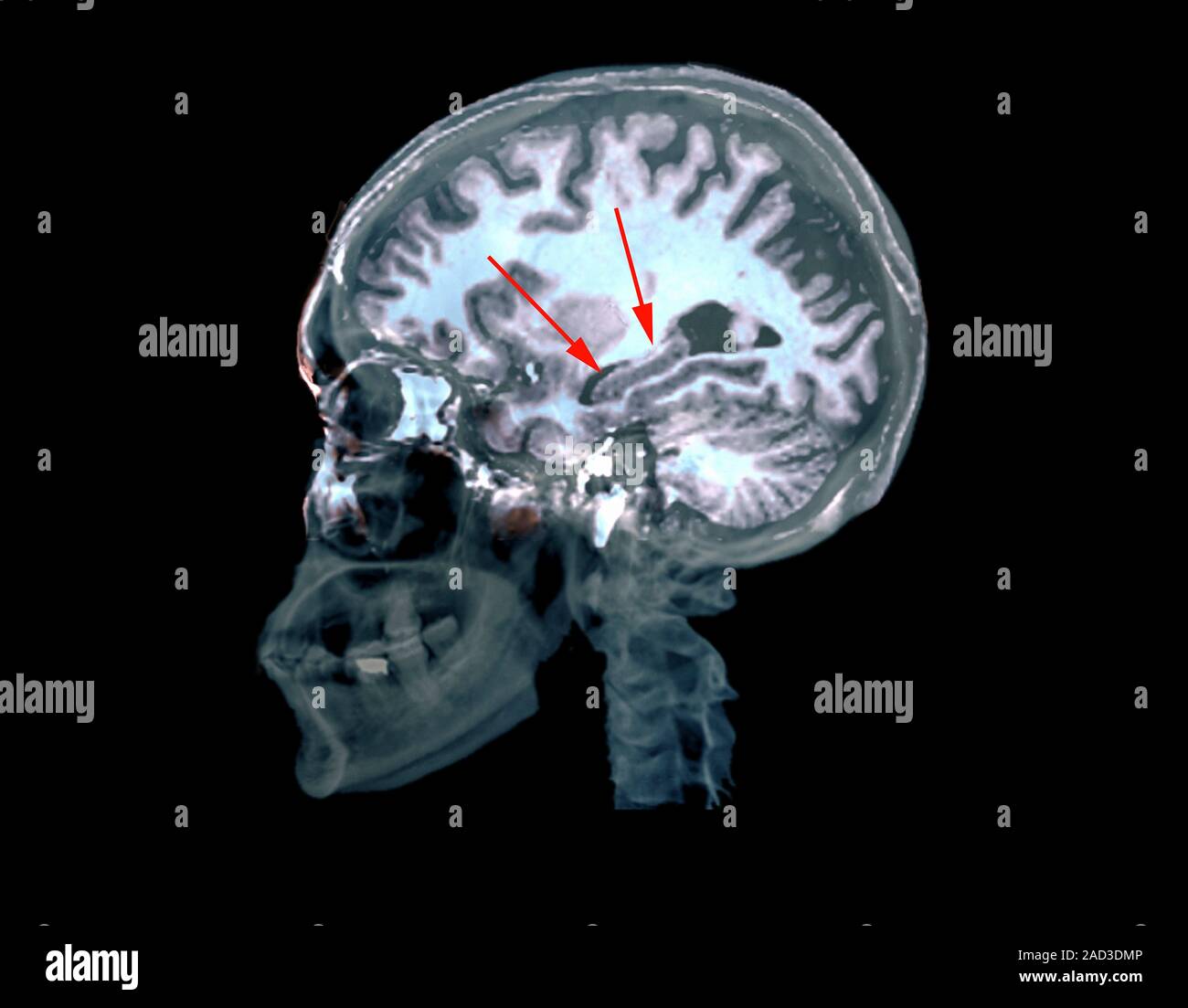 Brain in Alzheimer's disease. Magnetic resonance imaging (MRI) scan of ...