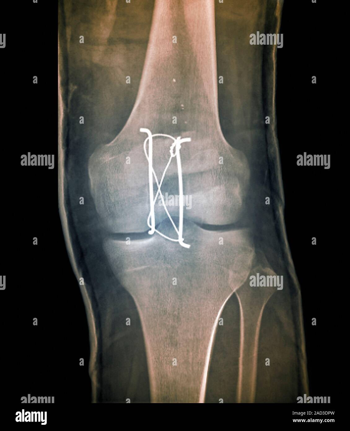 Pinned kneecap fracture. Coloured frontal Xray of a section through the knee of a 19yearold