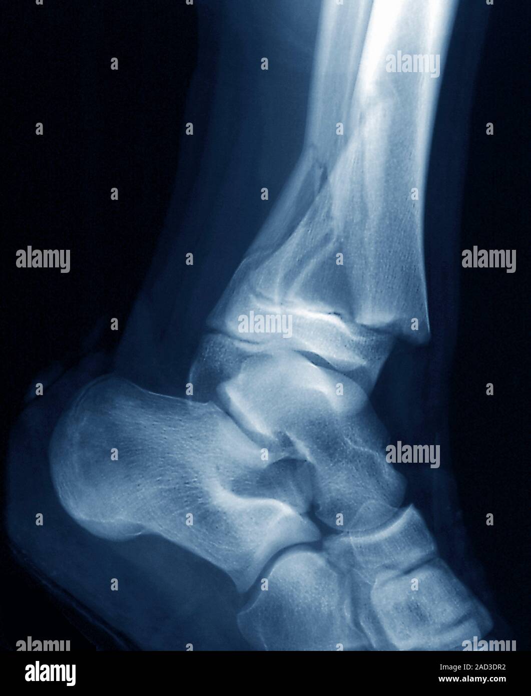 Fractured ankle. Xray of a section through the right ankle of a 13