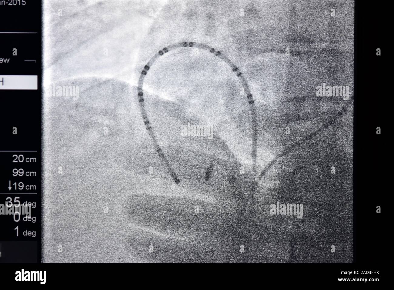 Cardiac ablation surgery. Heart Xray showing catheters (dark curved