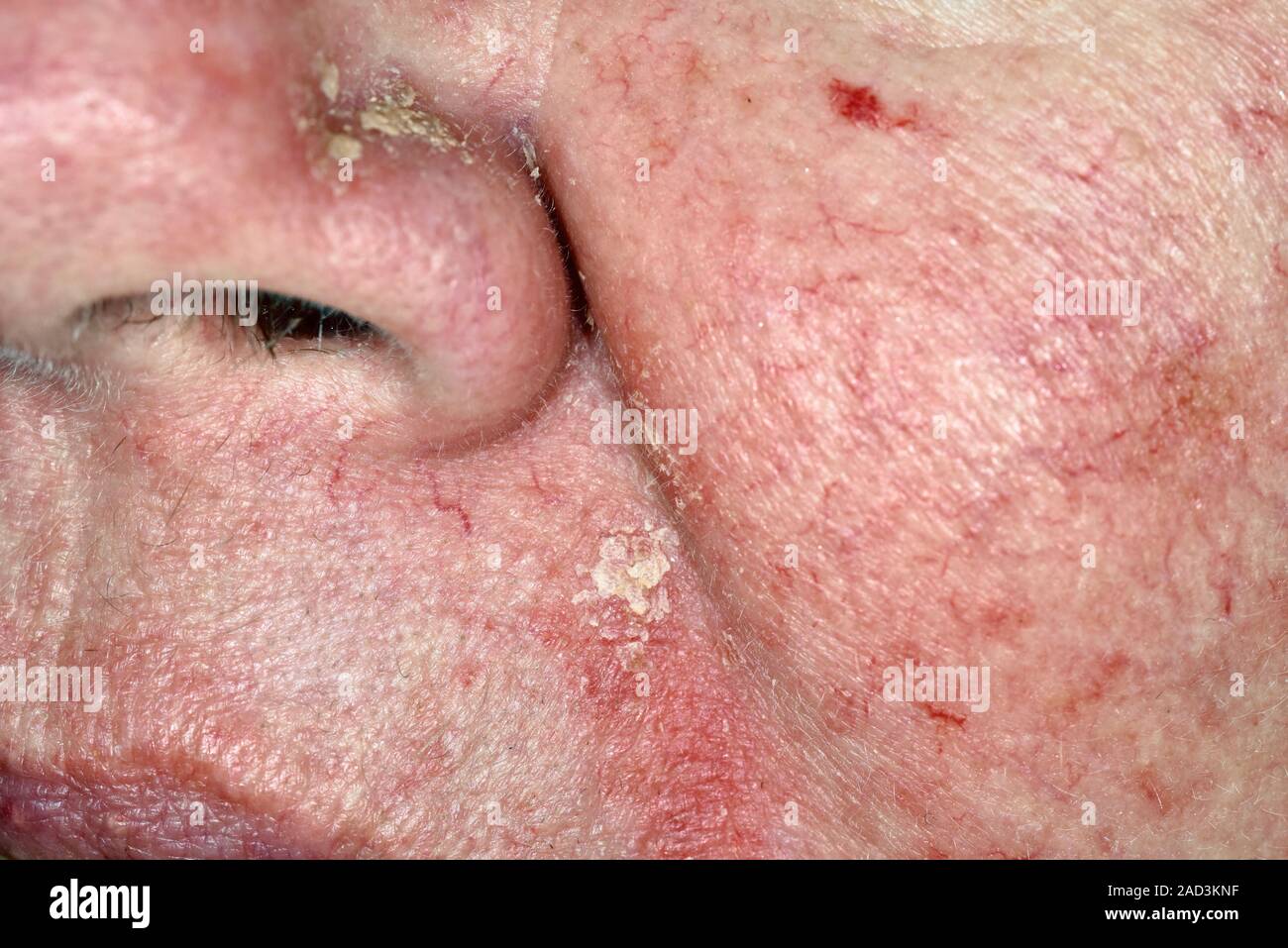 Seborrheic dermatitis. Closeup of a rash around the nose of a 64year