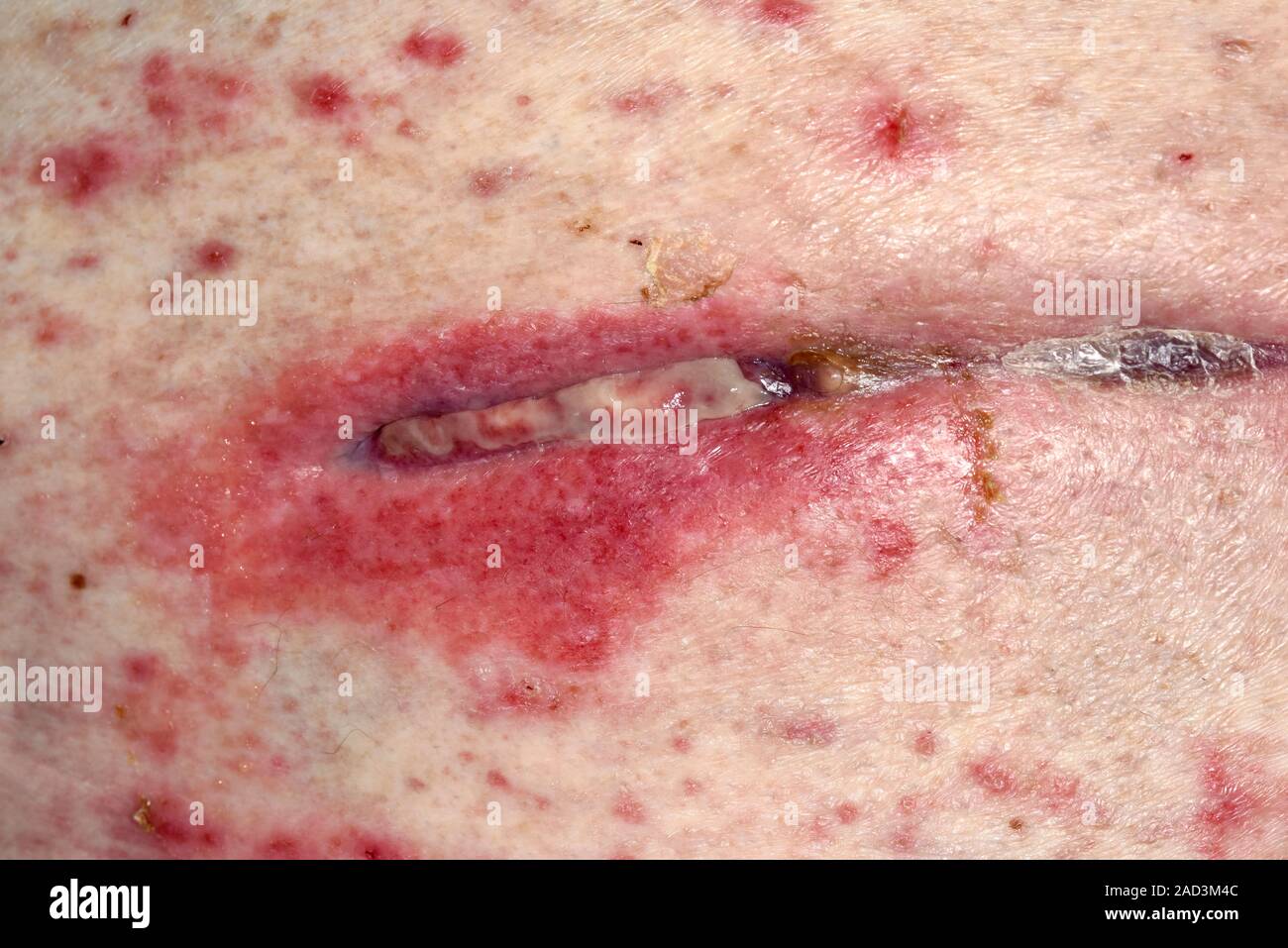 Allergic reaction to surgical dressing. Closeup of inflammation around