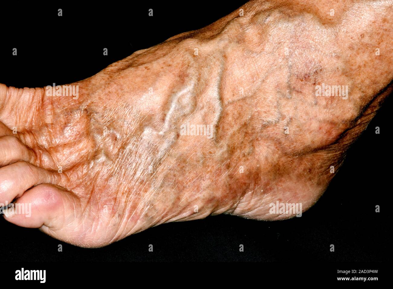 Varicose veins. Close-up of varicose veins on the foot of a 73-year-old ...