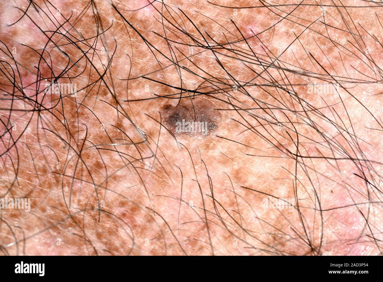 Mole. Closeup of a benign (noncancerous) mole on the chest of a 48