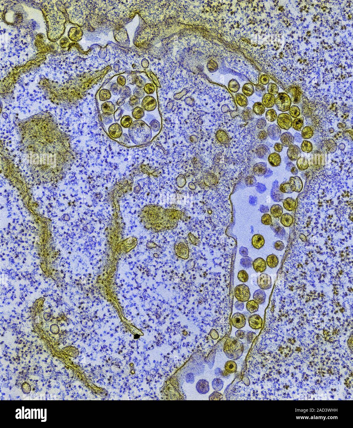 HIV infection. Coloured transmission electron micrograph (TEM) of a