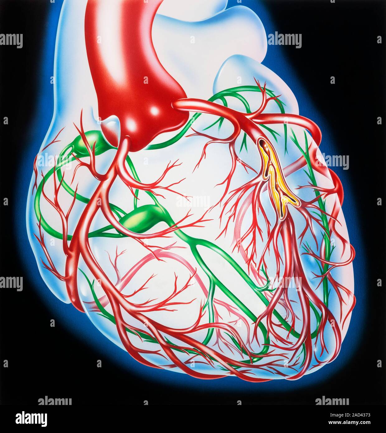 Coronary atherosclerosis. Illustration of a human heart showing