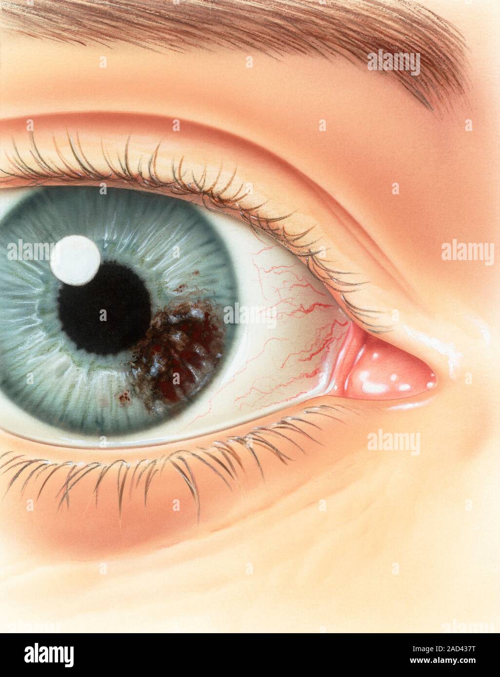 Melanoma of the iris. Illustration of the eye of a patient with a