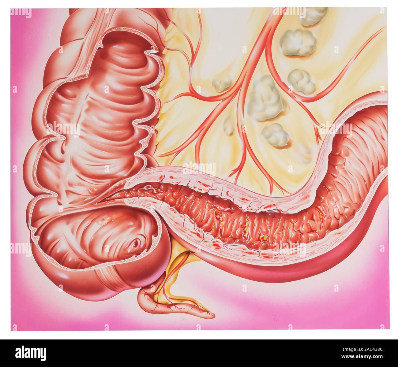 Crohn's disease. Cutaway illustration of the junction of the small and ...