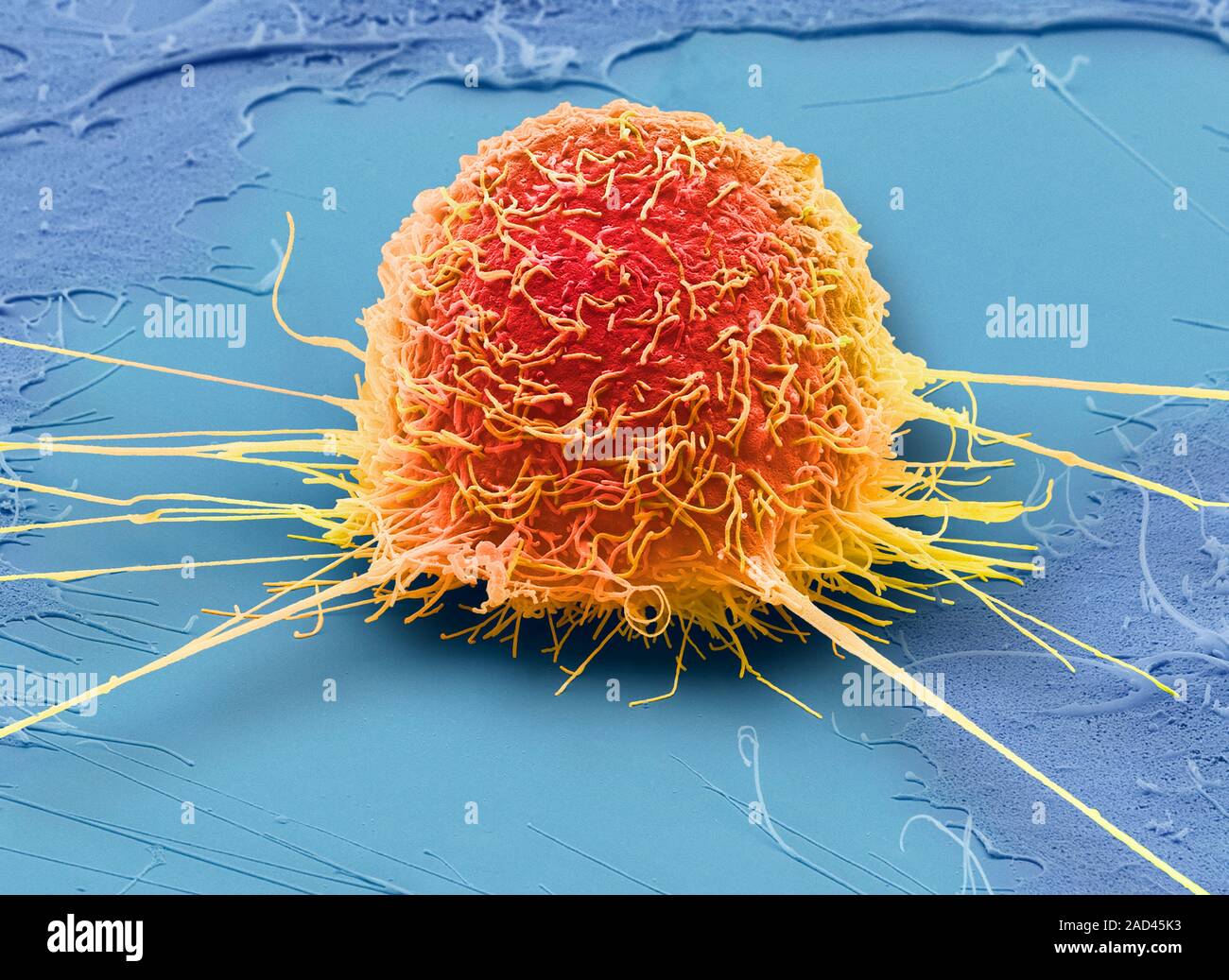 Mouth cancer cell. Coloured scanning electron micrograph (SEM) of a