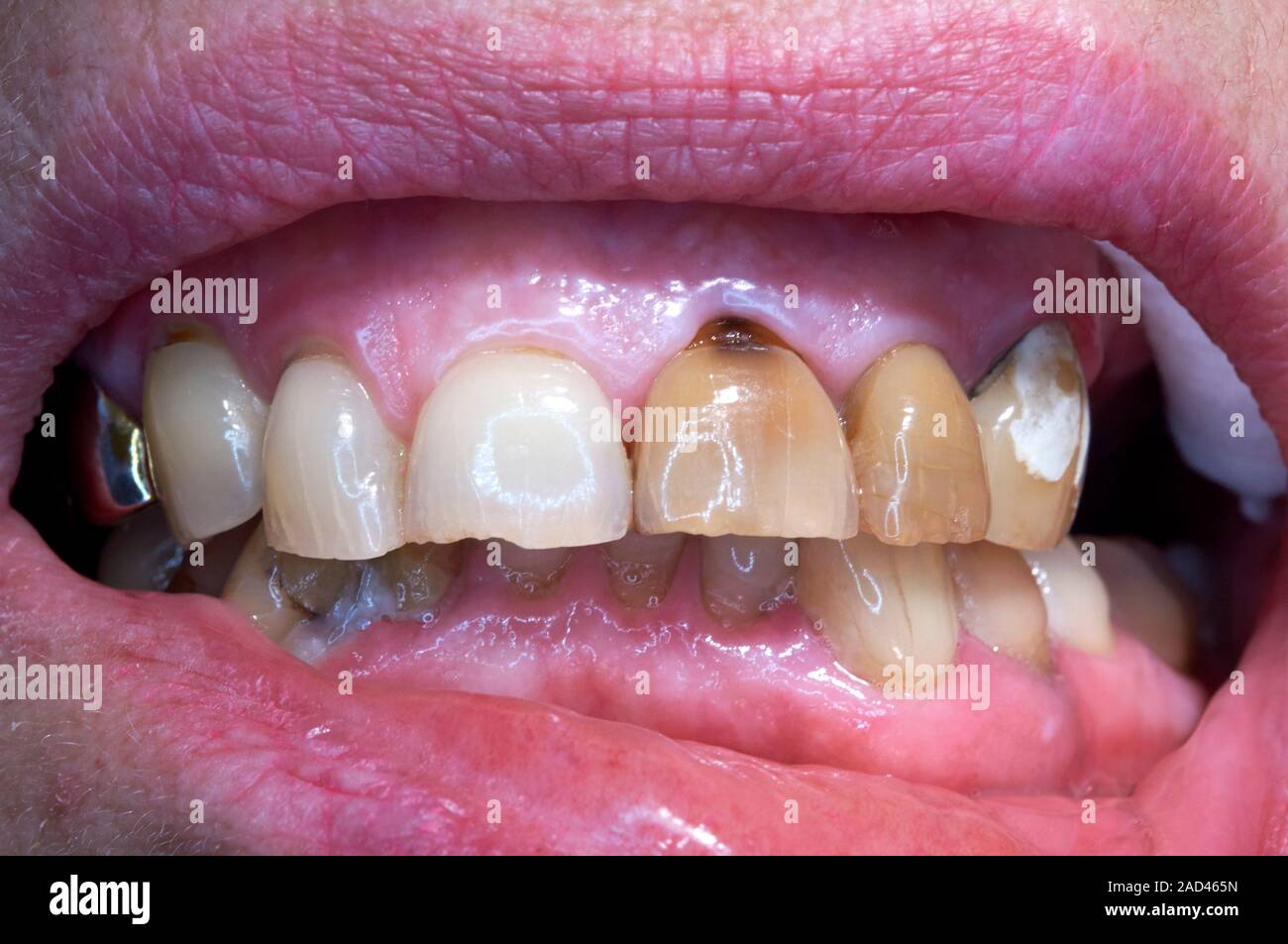 Dental caries. Changes in the colour of the upper incisors (right