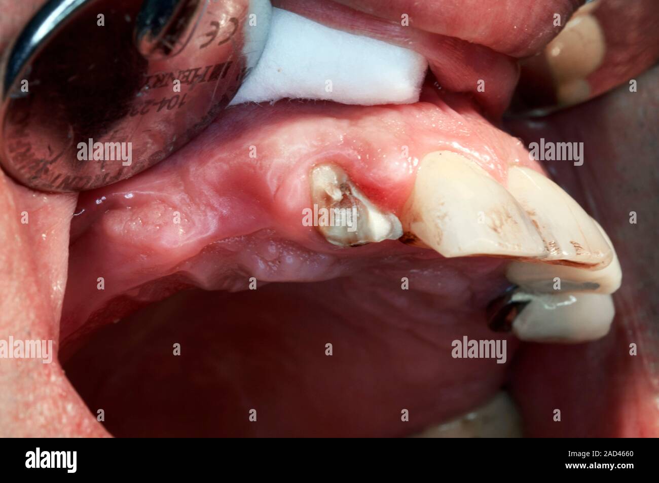Tooth Rupture Tooth fracture. Close up of a tooth fracture which was caused by trauma ...