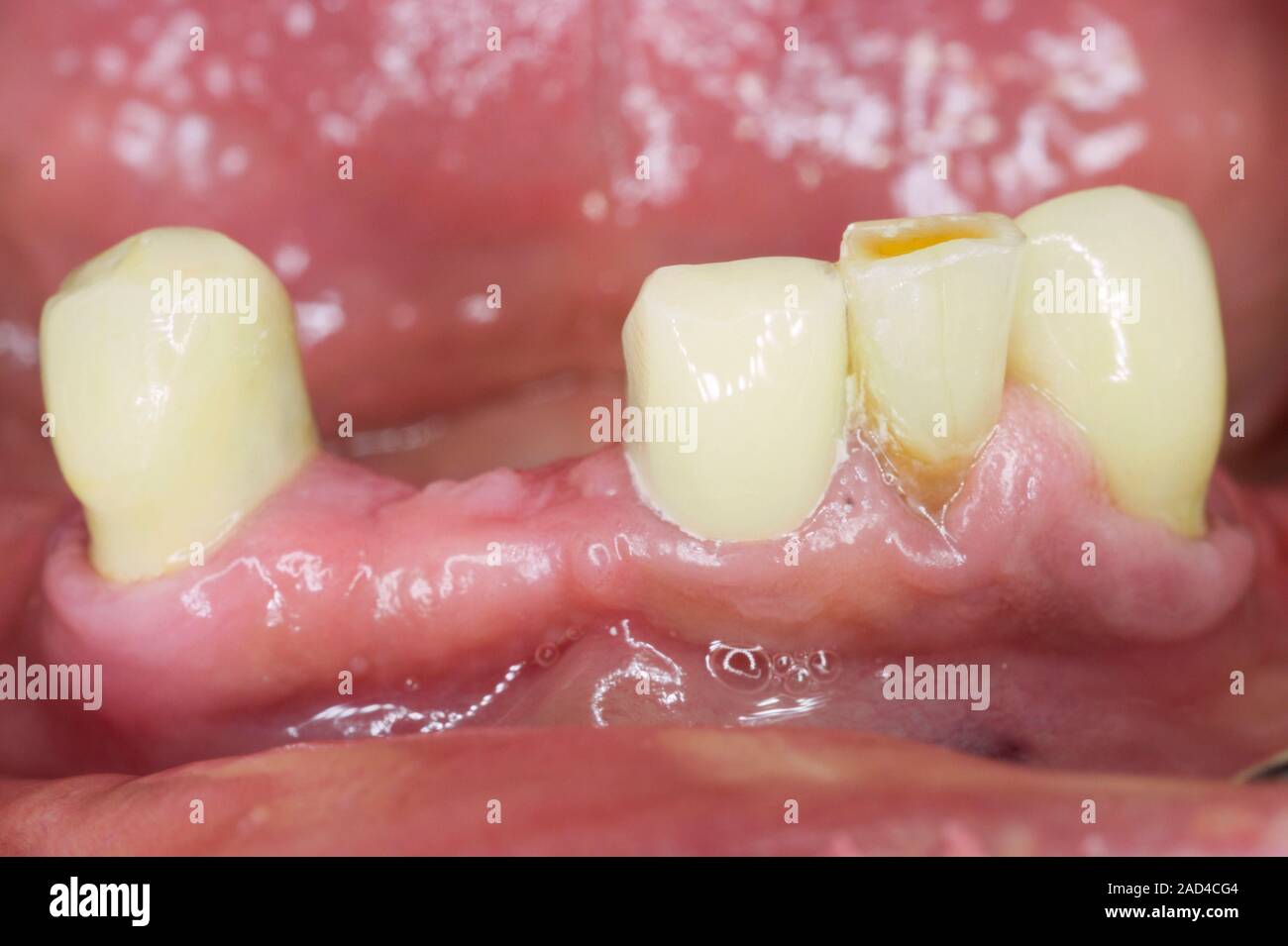 Dental crown. Closeup of a lower incisor tooth replaced by a plastic