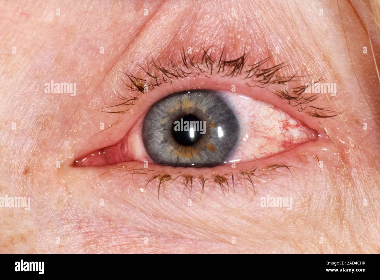 Allergic reaction to eyelash glue. Close-up of the inflamed red eye of ...