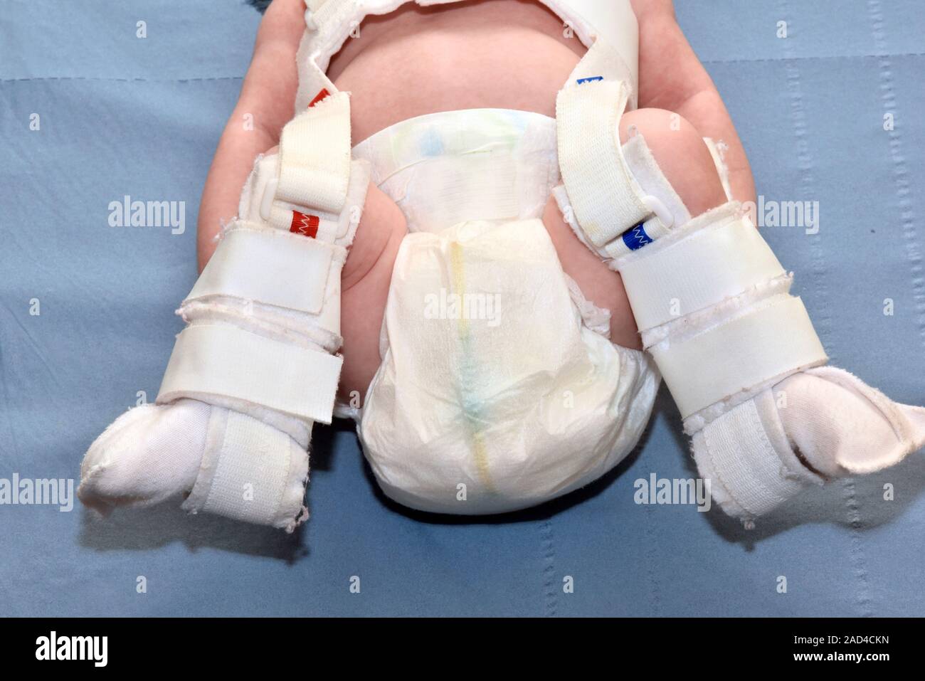 Pavlik harness in hip dysplasia. Closeup of a Pavlik harness being