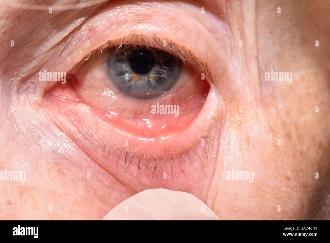 Meibomian cyst. Close-up of a meibomian abscess on the lower eyelid of a 72-year-old female patient. A meibomian cyst (chalazion) is caused when the s Stock Photo