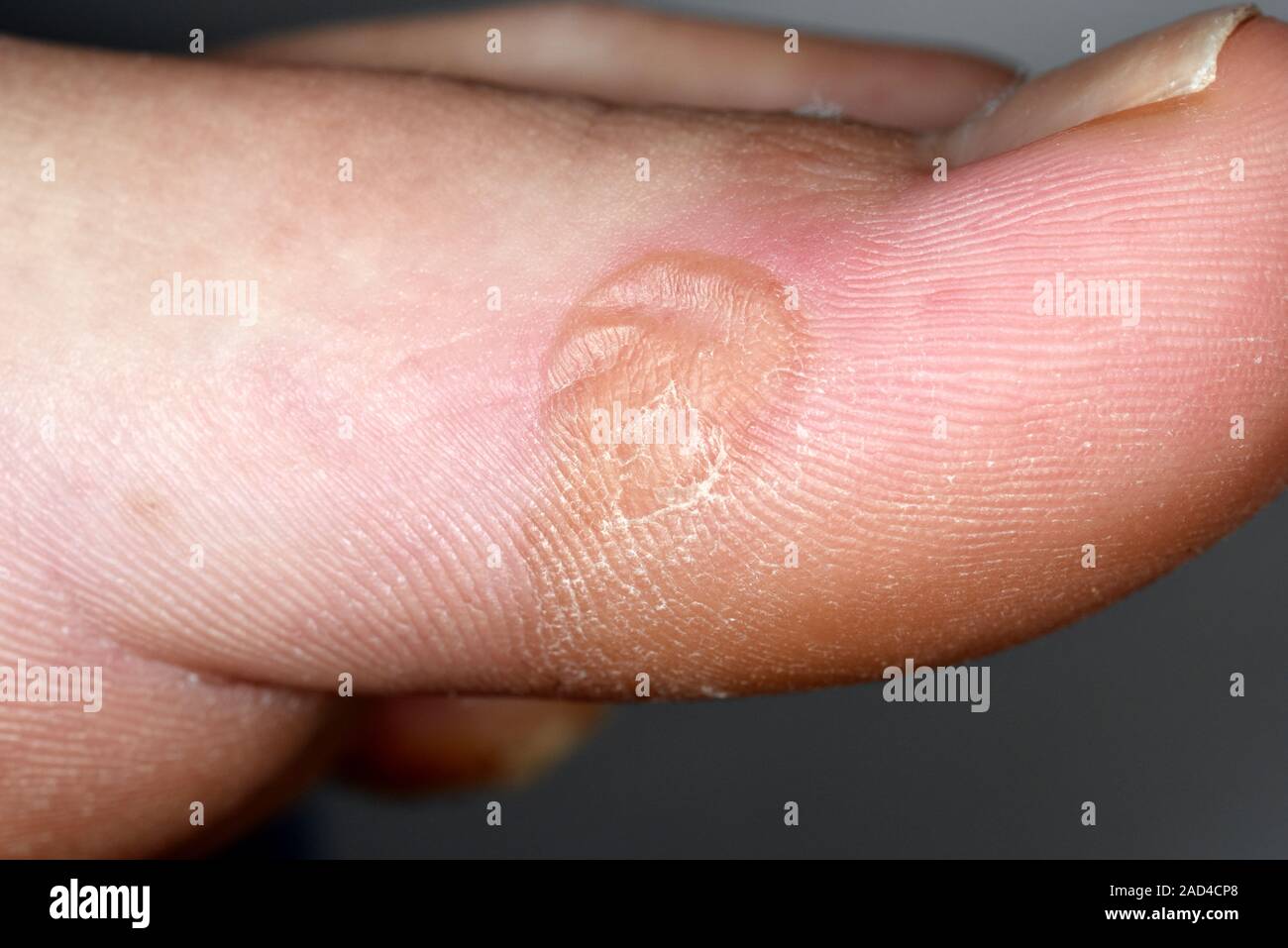 Blisters. Close-up of blisters on the toe of a 21-year-old female ...