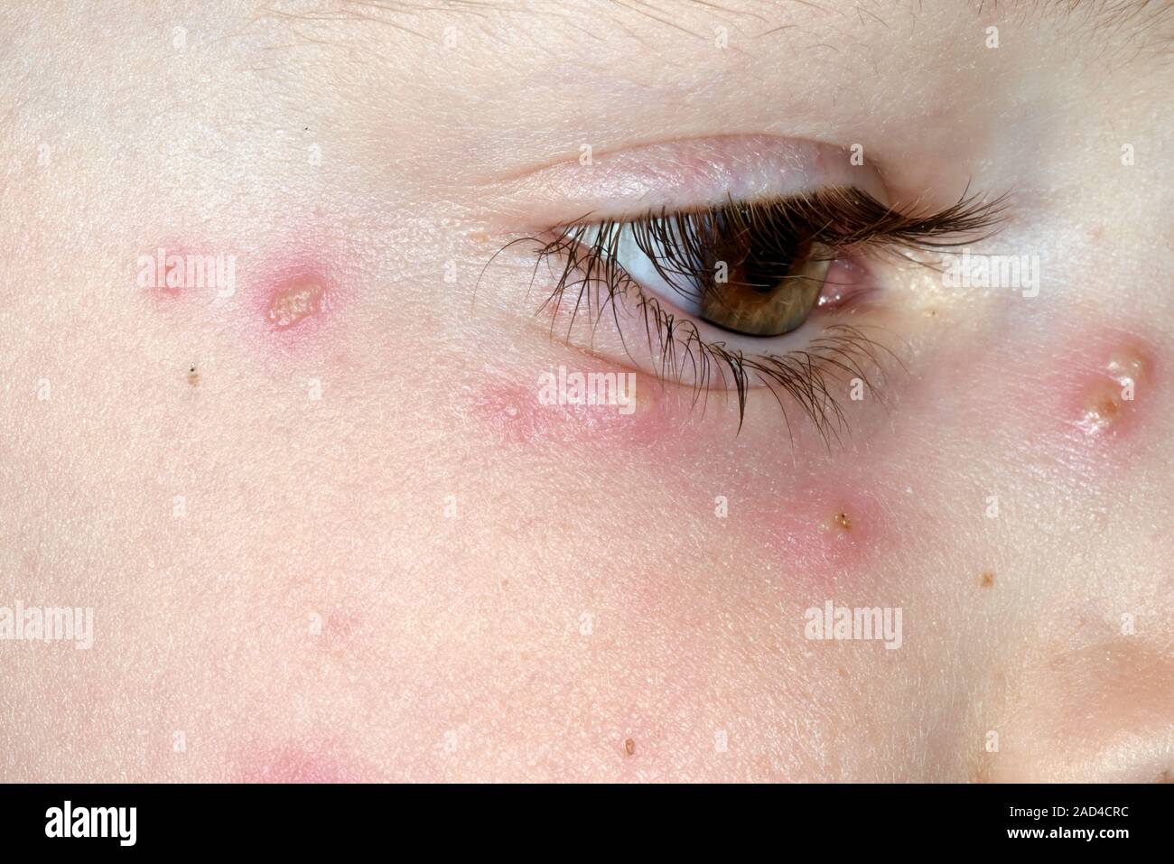 Chickenpox rash. Close-up of a rash on the face of a 5-year-old male
