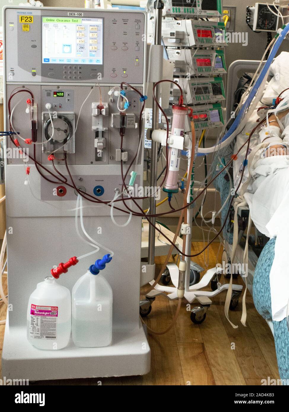 Haemodialysis machine being used to support a patient with kidney