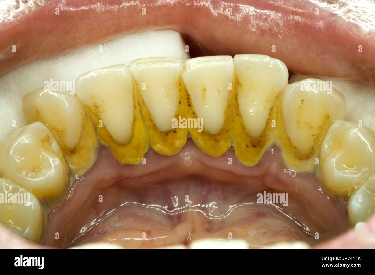 Teeth covered with plaque and tartar. Closeup of a dental patient's