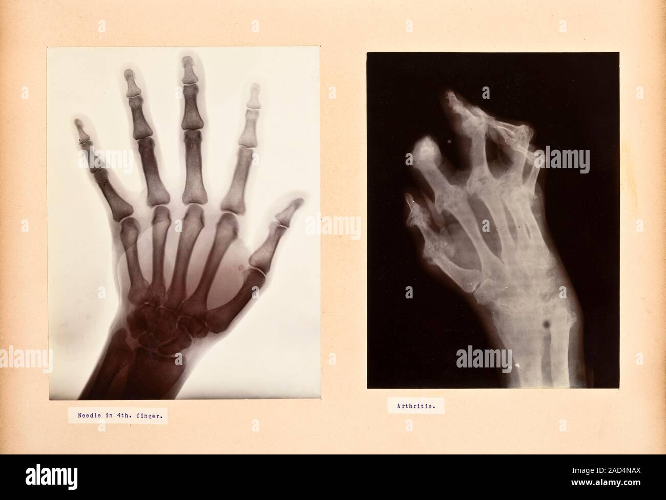 Hand disorder X-rays, showing a needle in a finger (left) and an ...