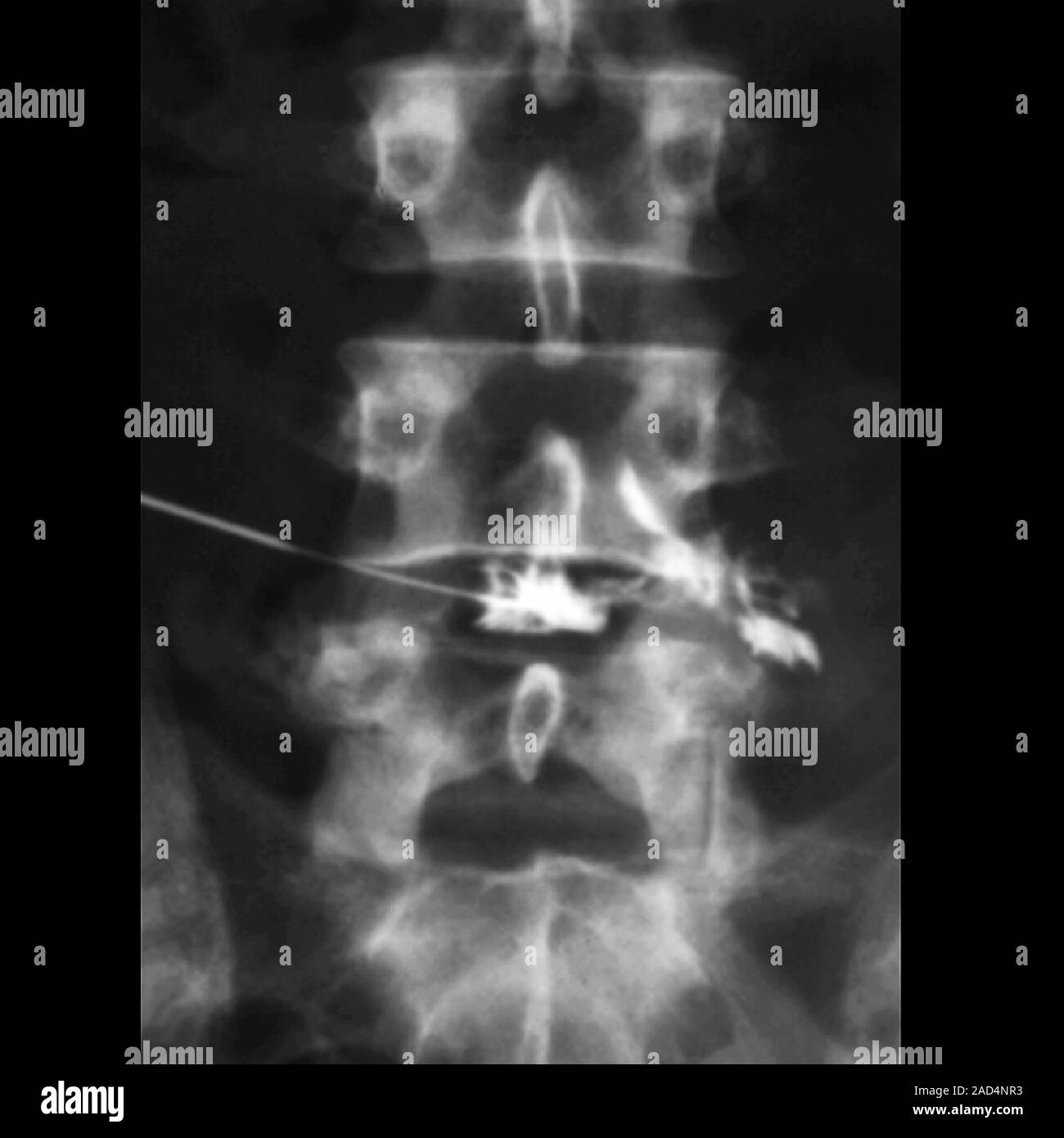 Slipped disc. Frontal Xray of a section through the lumbar spine of a