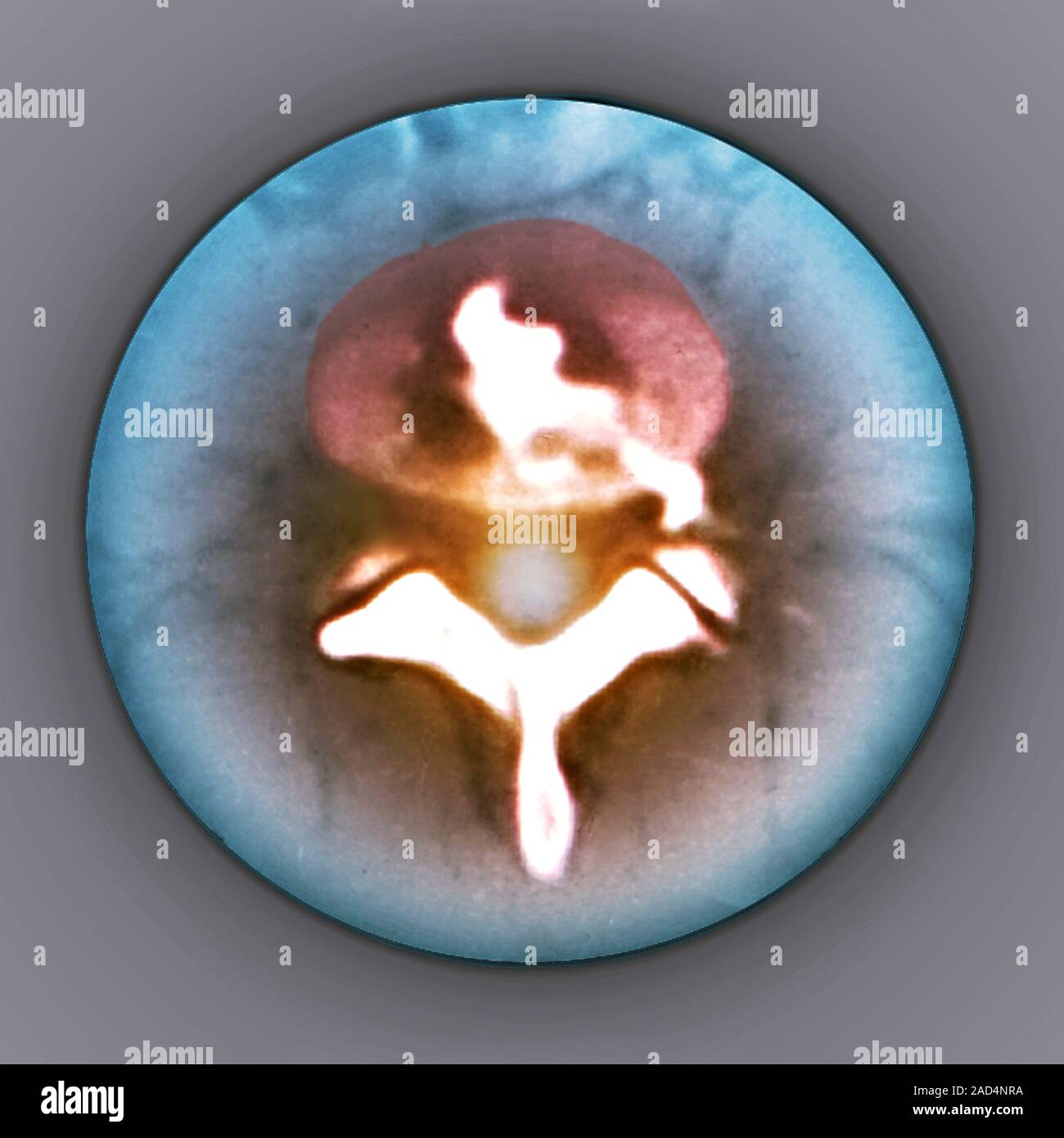 Slipped disc. Coloured computed tomography (CT) scan of an axial ...