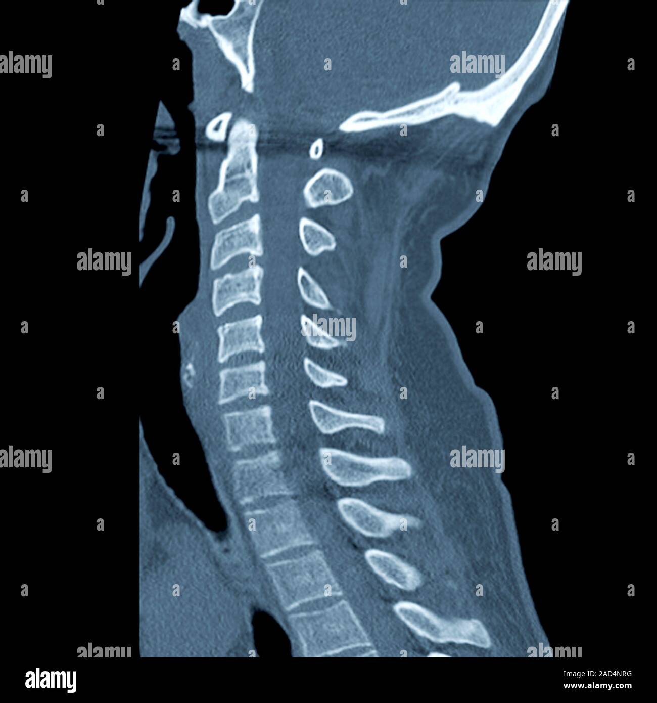 Slipped disc. Computed tomography (CT) scan of a section through the