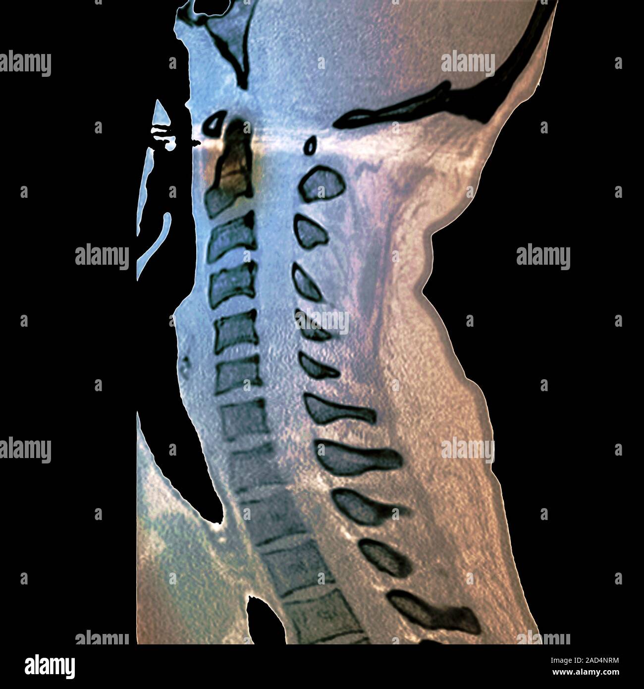 Slipped disc. Coloured computed tomography (CT) scan of a section