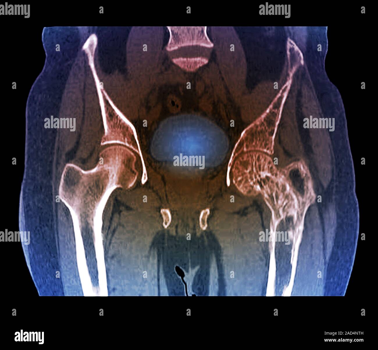 Hips in Paget's disease. Coloured computed tomography (CT) scan of the