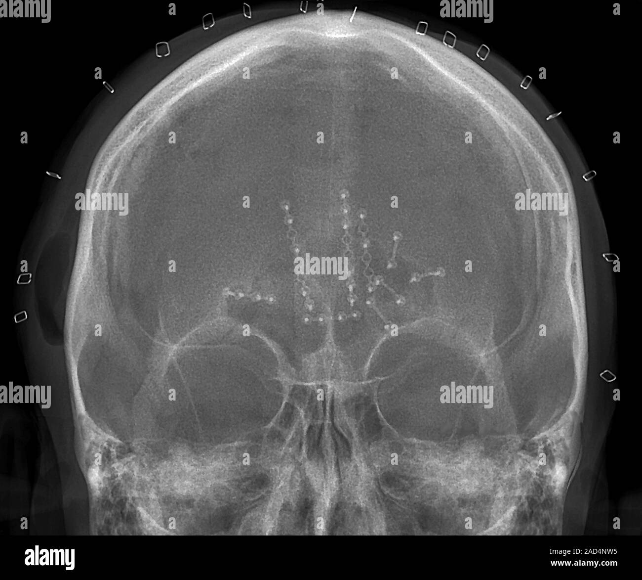 Fixed skull fractures after road accident. Frontal Xray of a section through the skull of a 57