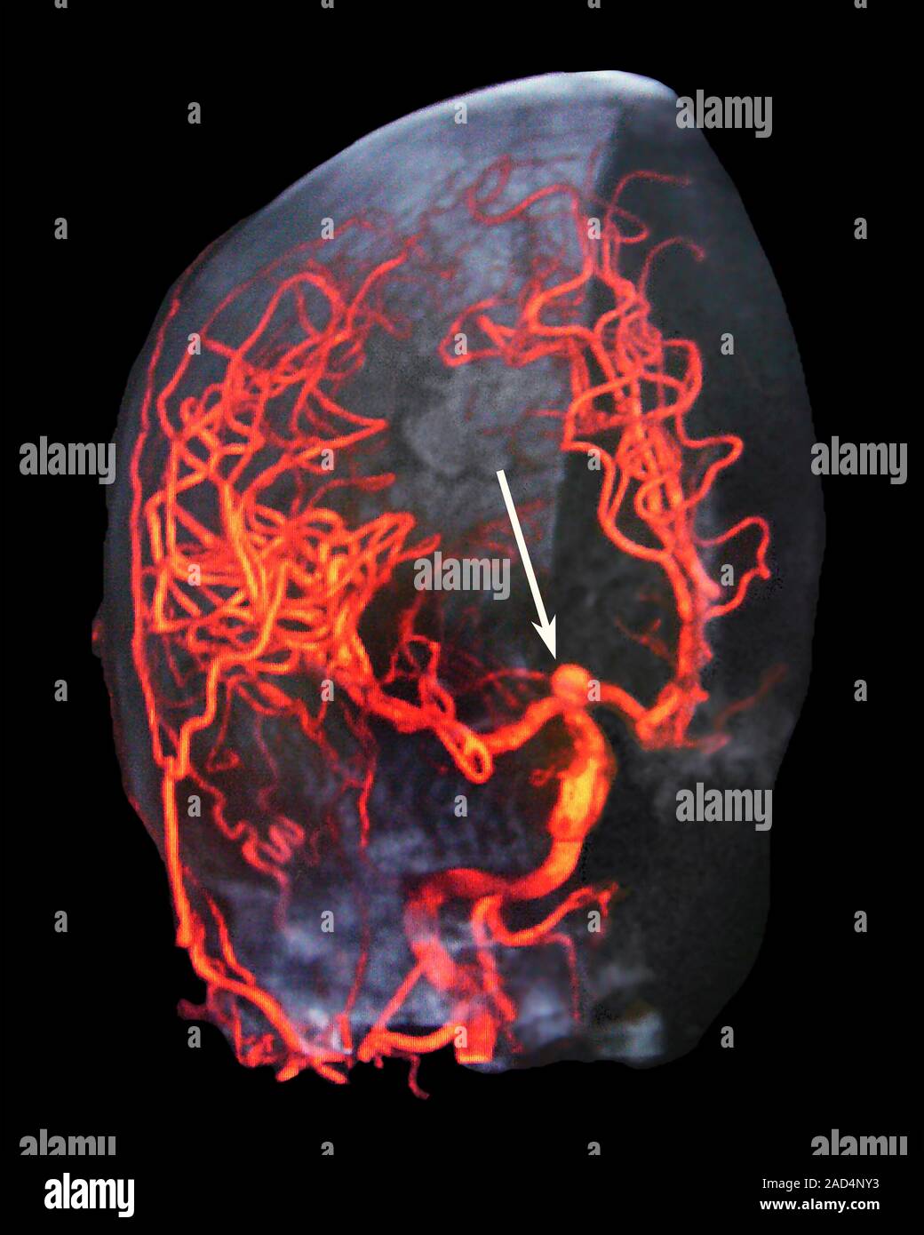 Brain haemorrhage. Coloured 3D angiogram of the right common carotid ...